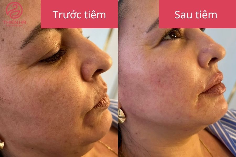 Tiêm tan mỡ là gì? Hiệu quả, chi phí và rủi ro bạn cần biết 2 Kết quả sau tiêm vùng điều trị thon gọn