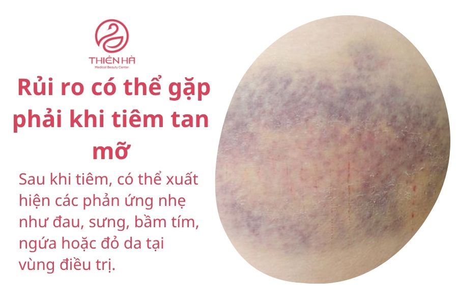 Tiêm tan mỡ là gì? Hiệu quả, chi phí và rủi ro bạn cần biết 3 Rủi ro có thể gặp phải khi tiêm tan mỡ