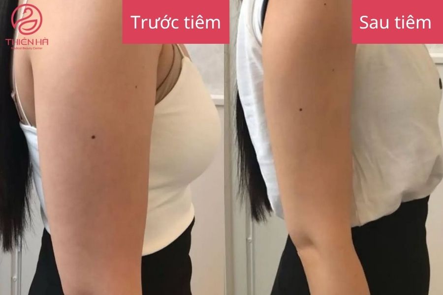 Kết quả sau tiêm tan mỡ bắp tay : Bắp tay thon gọn 
