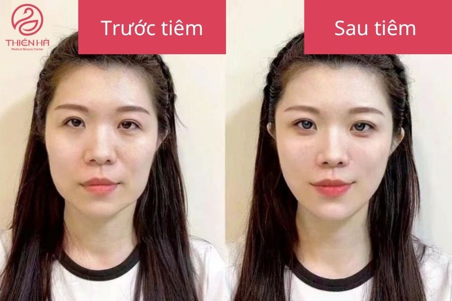 Kết quả sau tiêm tan mỡ má 