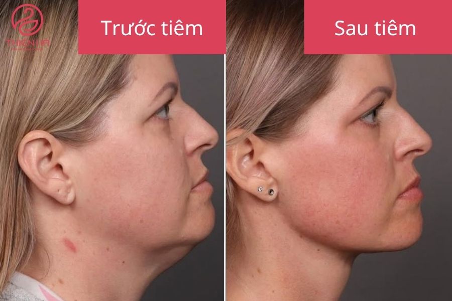 Kết quả sau tiêm tan mỡ nọng cằm giảm mỡ rõ rệt 
