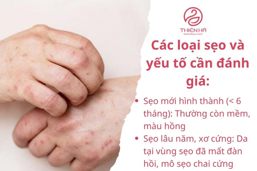 Trị sẹo thủy đậu hiệu quả: Từ mẹo tự nhiên đến công nghệ mới 2 Phân loại và đánh giá mức độ sẹo thủy đậu