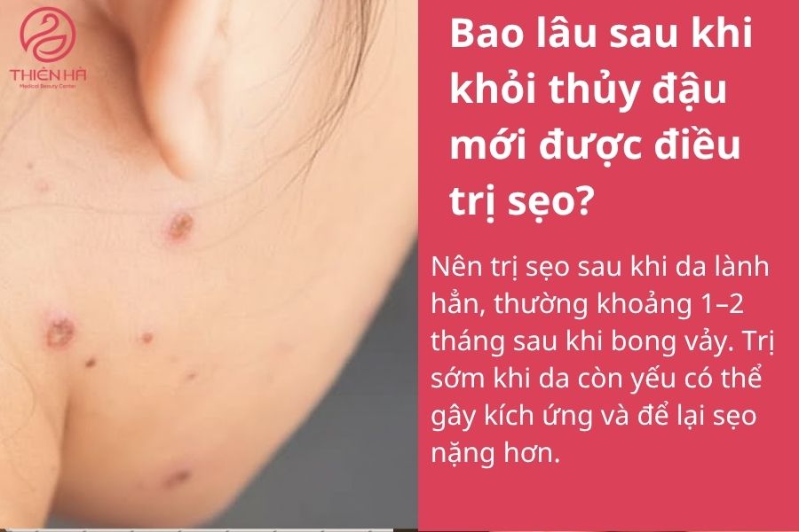Trị sẹo thủy đậu hiệu quả: Từ mẹo tự nhiên đến công nghệ mới 8 Một số câu hỏi thường gặp