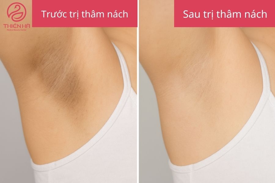 Kết quả sau điều trị thâm nách bằng laser nách hết thâm
