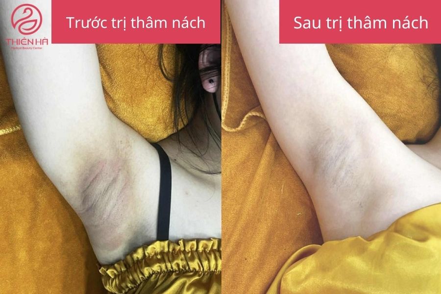 Kết quả sau điều trị thâm nách 