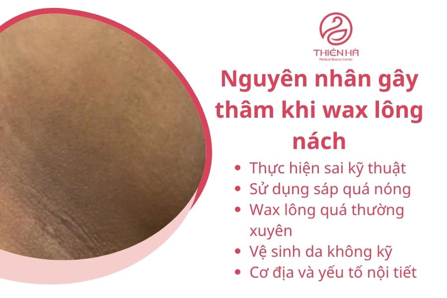 Nguyên nhân gây thâm khi wax lông nách