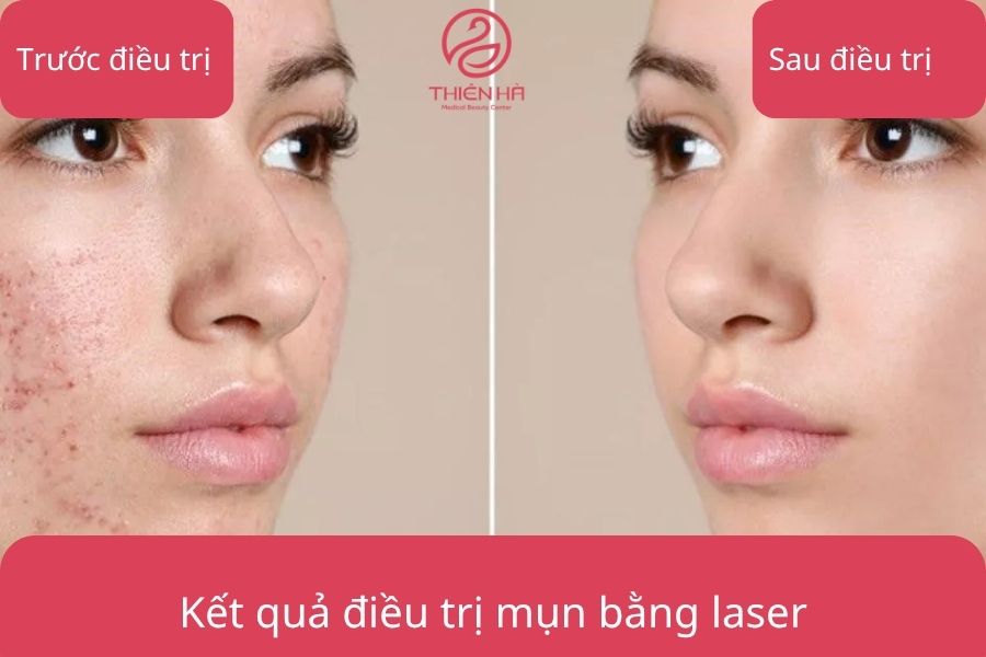 Bắn Tia Laser Trị Mụn: Hiệu Quả, Ưu Nhược Điểm & Chi Phí 2 Kết quả điều trị mụn bằng laser