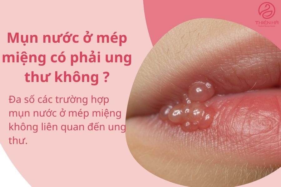 Bị nổi mụn nước ở mép miệng là gì? Nguyên nhân và cách xử lý an toàn 4 Câu hỏi thường gặp về bị nổi mụn nước ở mép miệng