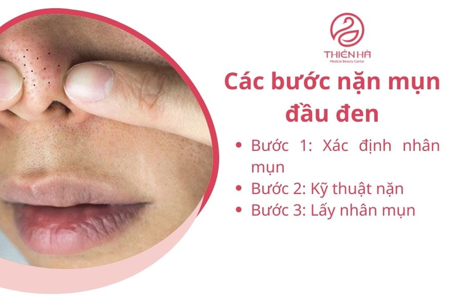 Các bước nặn mụn đầu đen 