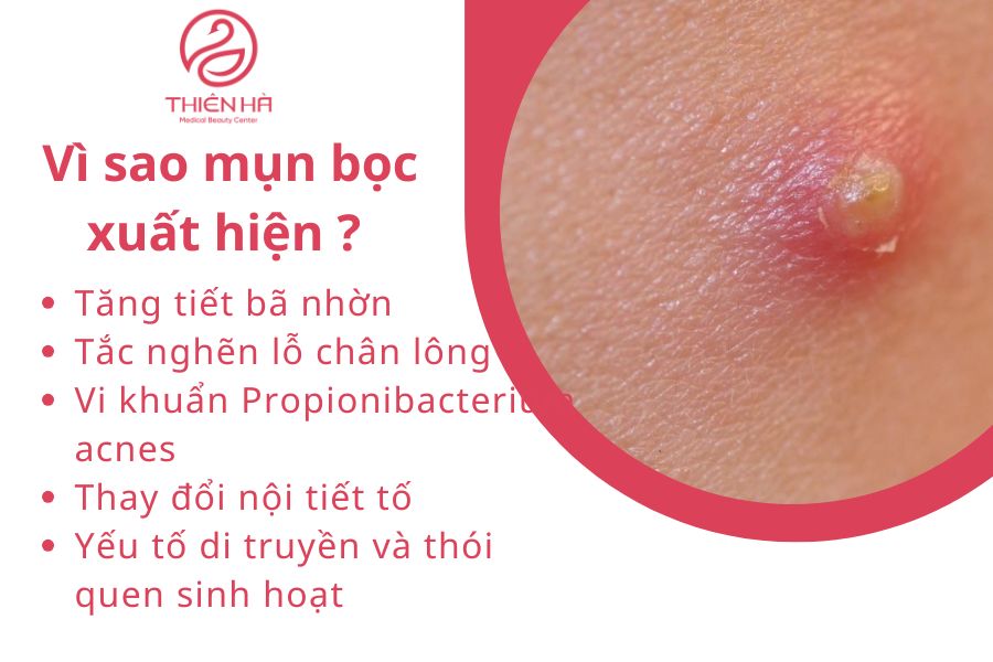 Vì sao mụn bọc xuất hiện ?