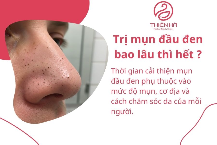 Trị mụn đầu đen bao lâu thì hết?