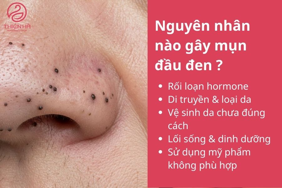 Nguyên nhân nào gây mụn đầu đen ? 