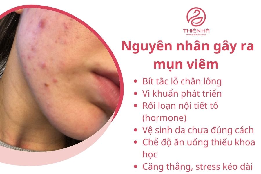Nguyên nhân gây ra mụn viêm 