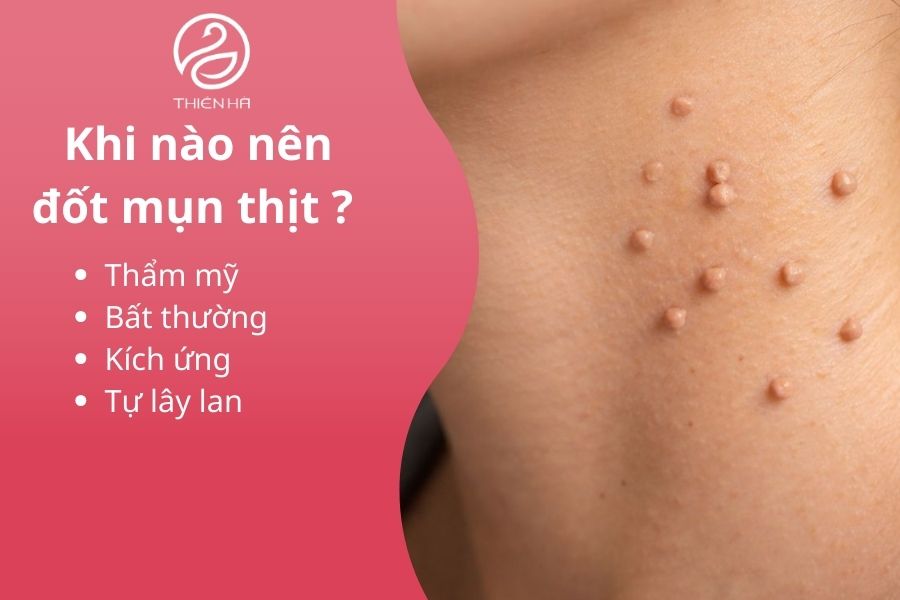 Khi nào nên đốt mụn thịt ? 