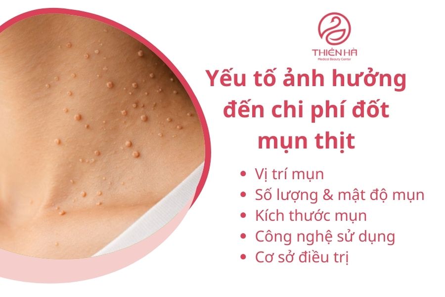 Các yếu tố ảnh hưởng đến chi phí đốt mụn thịt