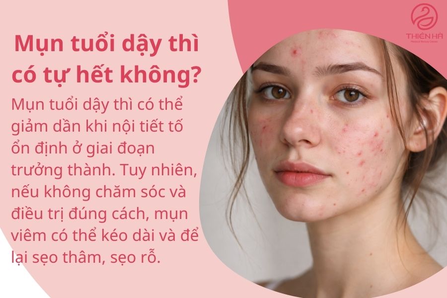 Câu hỏi thường gặp khi chữa mụn trứng cá ở tuổi dậy thì