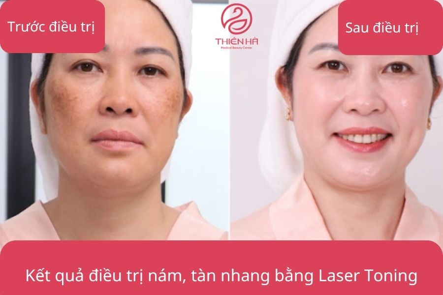 Hình ảnh thực tế điều trị nám, tàn nhang bằng Laser Toning