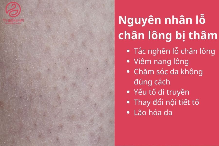 Nguyên nhân lỗ chân lông bị thâm