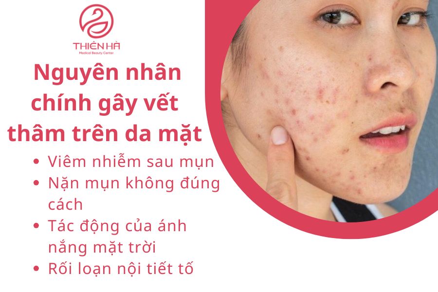 Nguyên nhân hình thành vết thâm trên mặt