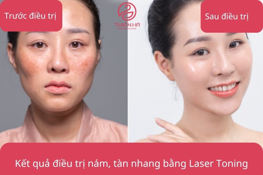 Hình ảnh minh họa kết quả điều trị nám, tàn nhang, da không đều màu bằng Laser Toning