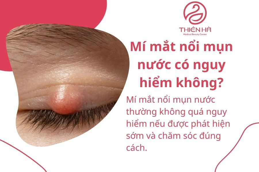 Mí mắt nổi mụn nước: Nguyên nhân, dấu hiệu & cách xử lý an toàn 2 Mí mắt nổi mụn nước có nguy hiểm không?