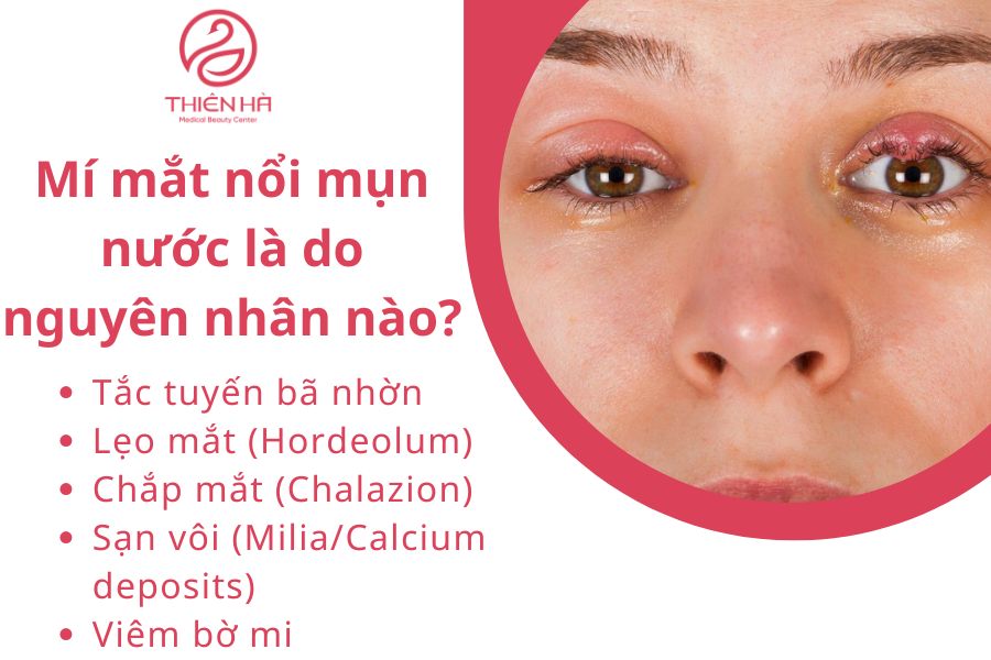 Mí mắt nổi mụn nước: Nguyên nhân, dấu hiệu & cách xử lý an toàn 1 Mí mắt nổi mụn nước là do nguyên nhân nào?
