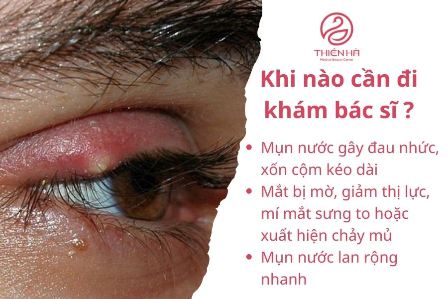 Mí mắt nổi mụn nước: Nguyên nhân, dấu hiệu & cách xử lý an toàn 4 Dấu hiệu cần đi khám