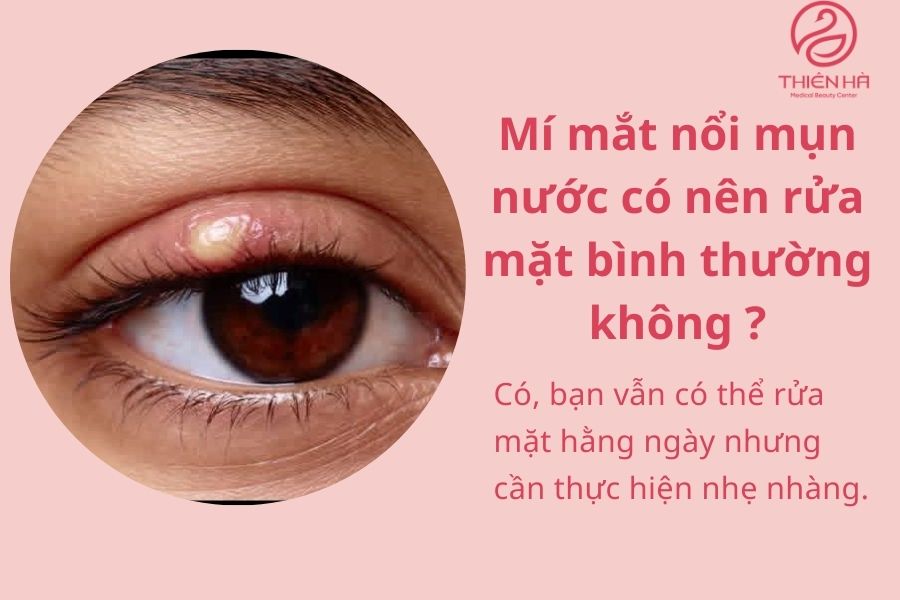 Mí mắt nổi mụn nước: Nguyên nhân, dấu hiệu & cách xử lý an toàn 5 Một số câu hỏi thường gặp về mí mắt nổi mụn nước