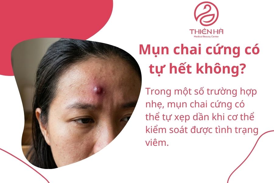 Mụn bị chai cứng dưới da phải làm sao? Cách xử lý an toàn 6 Câu hỏi thường gặp về mụn chai cứng