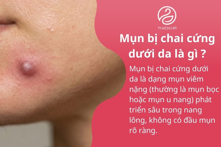 Mụn bị chai cứng dưới da phải làm sao? Cách xử lý an toàn 1 Mụn bị chai cứng dưới da là gì?