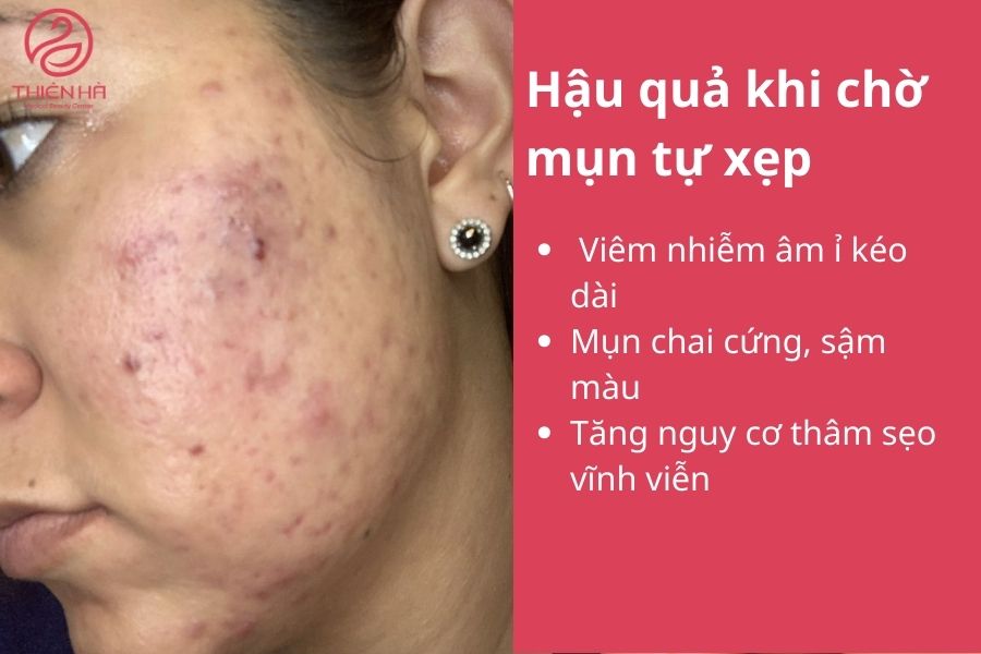 Hậu quả khi chờ mụn tự xẹp