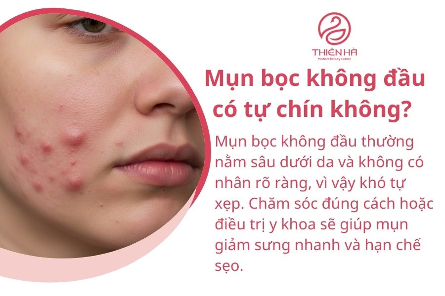 Mụn bọc không đầu có tự chín không?