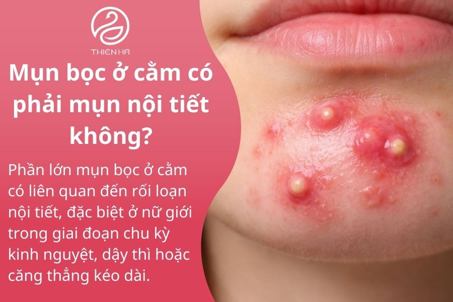 Một số câu hỏi thường gặp về mụn bọc ở cằm 