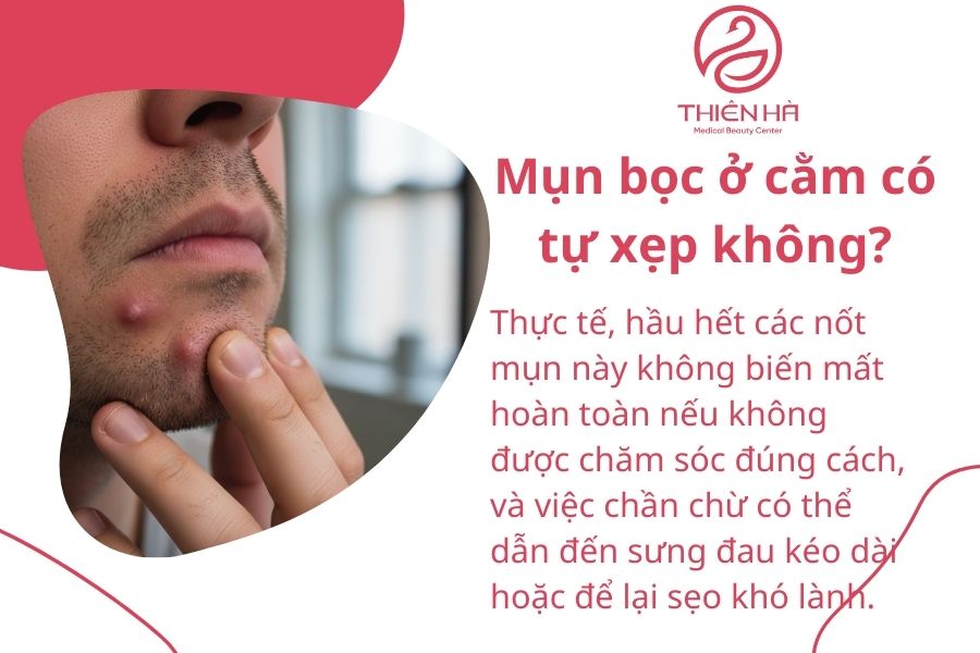Mụn bọc ở cằm có tự xẹp không?