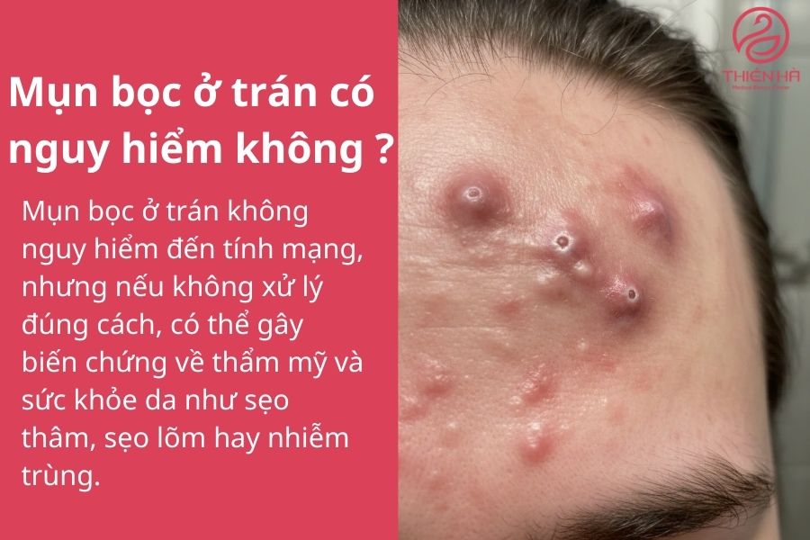 Mụn bọc ở trán có nguy hiểm không ?