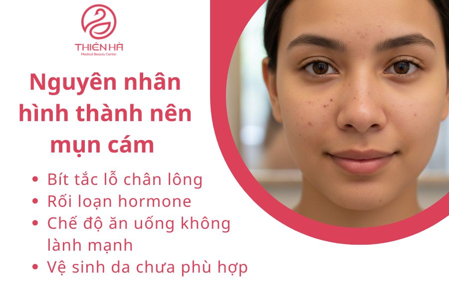 Nguyên nhân hình thành nên mụn cám 