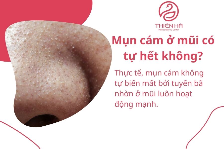 Mụn cám ở mũi có tự hết không?
