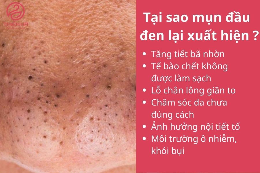 Tại sao mụn đầu đen lại xuất hiện ? 