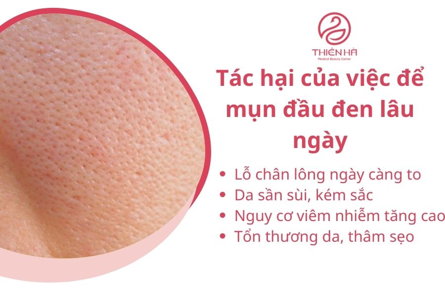 Mụn đầu đen để lâu có sao không?