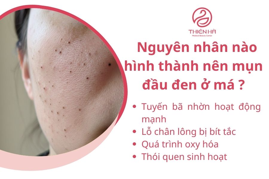 Nguyên nhân hình thành nên mụn đầu đen ở má 