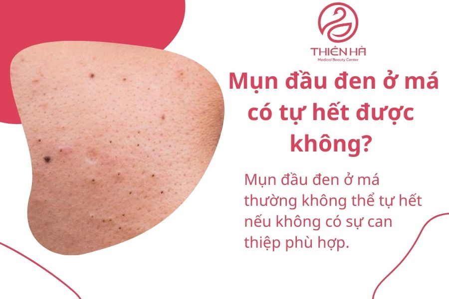 Mụn đầu đen ở má có tự hết được không?