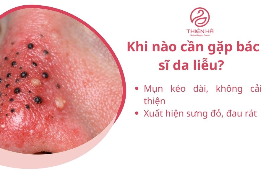 Mụn đầu đen ở mũi: Nguyên nhân và cách điều trị hiệu quả tại nhà 4 Khi nào cần gặp bác sĩ da liễu?