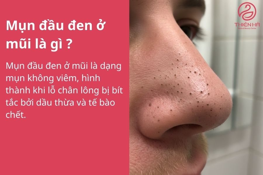 Mụn đầu đen ở mũi: Nguyên nhân và cách điều trị hiệu quả tại nhà 1 mun dau den o mui 2