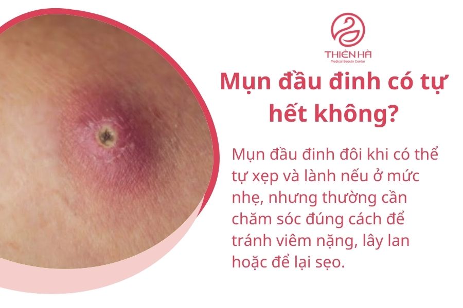 Mụn đầu đinh là gì? Dấu hiệu, nguyên nhân và cách trị hiệu quả 4 Một số câu hỏi về mụn đầu đinh