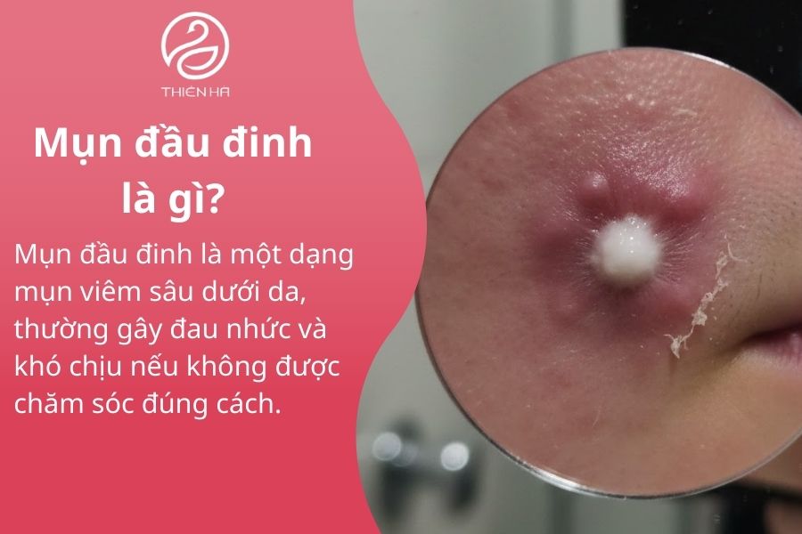 Mụn đầu đinh là gì? Dấu hiệu, nguyên nhân và cách trị hiệu quả 1 Mụn đầu đinh là gì?