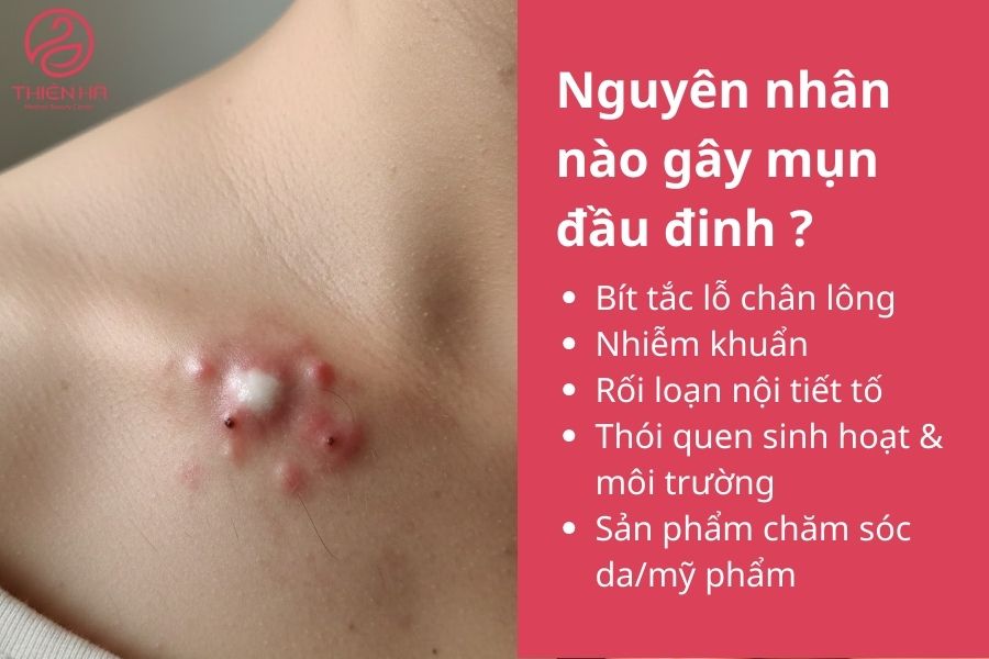 Mụn đầu đinh là gì? Dấu hiệu, nguyên nhân và cách trị hiệu quả 2 Nguyên nhân nào gây mụn đầu đinh ?