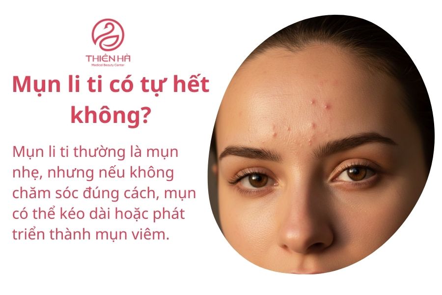 Câu hỏi thường gặp về mụn li ti 
