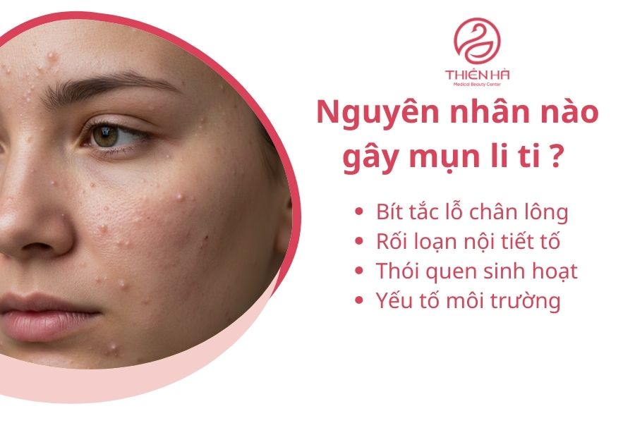 Nguyên nhân nào gây mụn li ti 