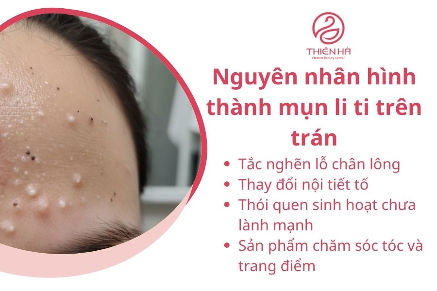 Nguyên nhân hình thành mụn li ti trên trán