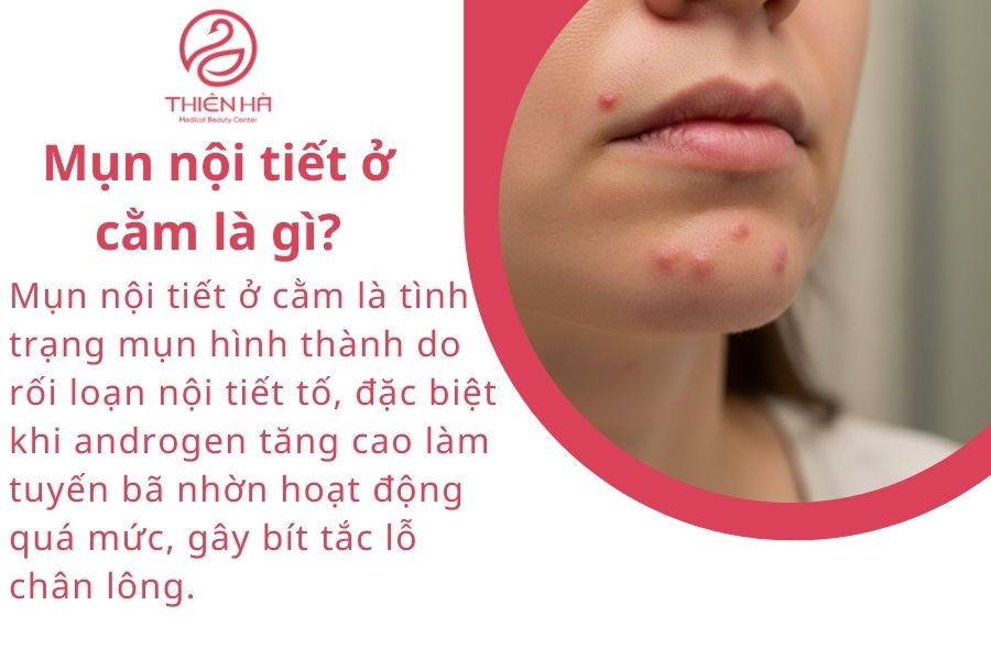 Mụn nội tiết ở cằm là gì? 